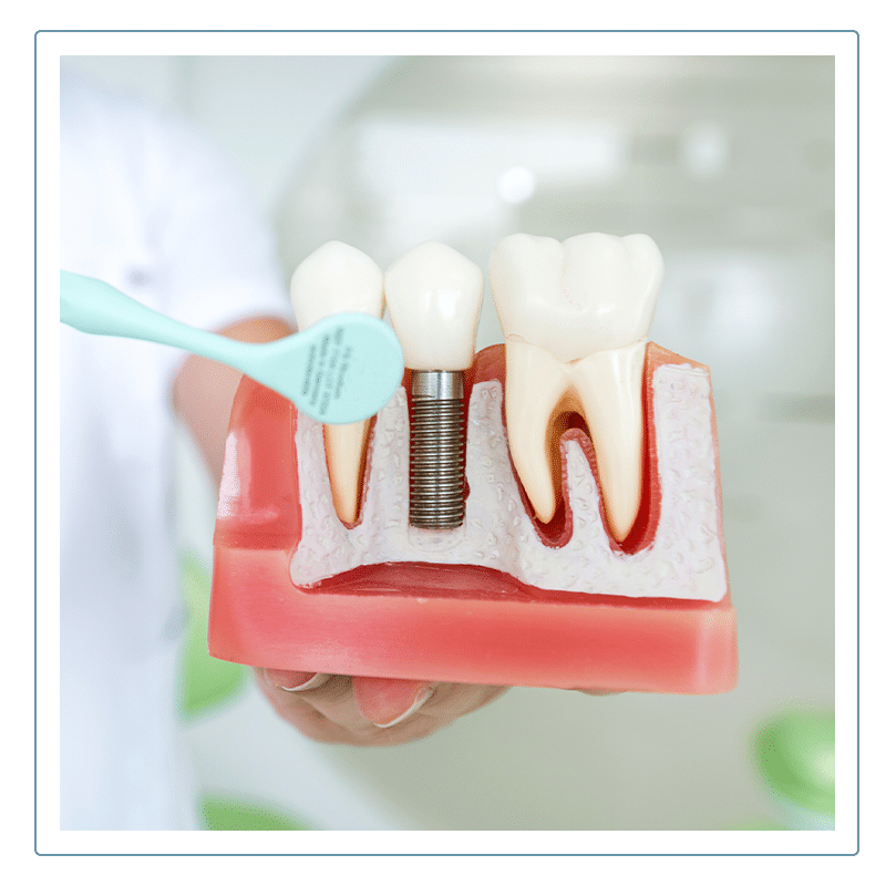 Diagram of tooth implants